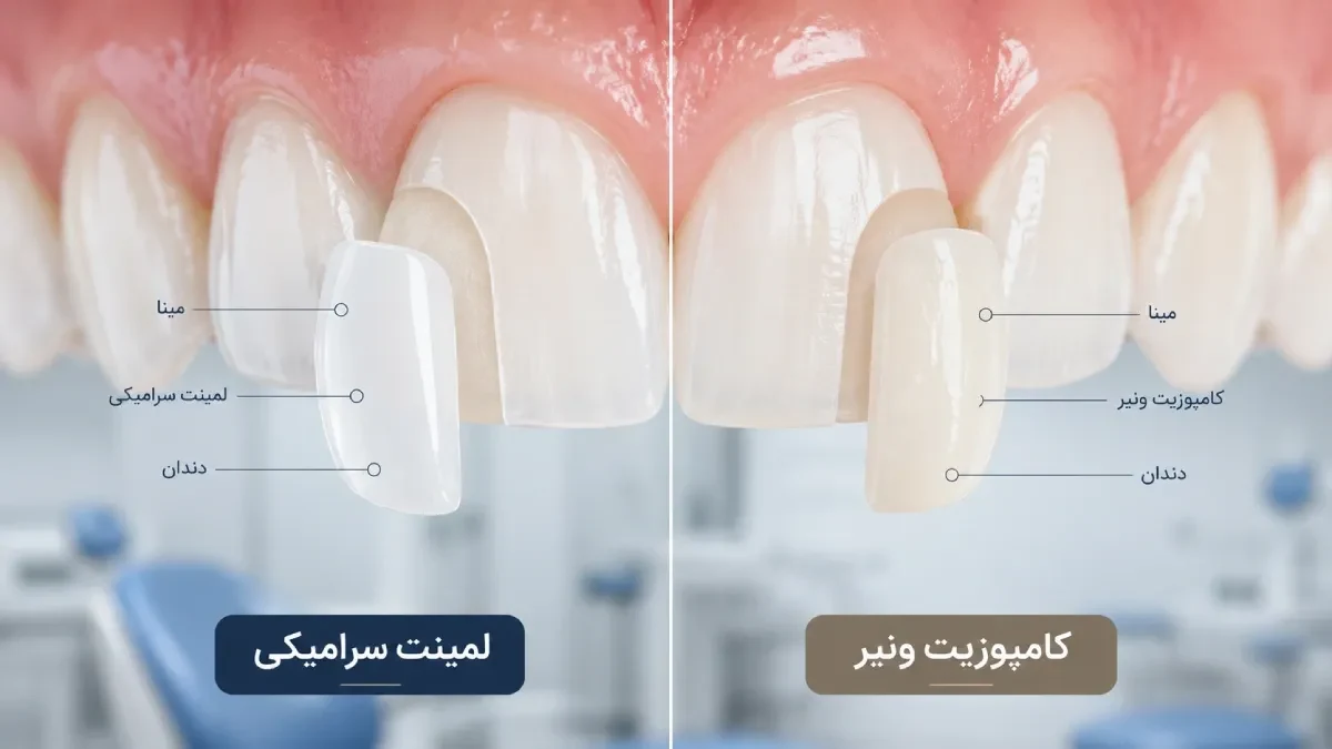 لمینت یا کامپوزیت ونیر؟ مقایسه کامل برای انتخاب بهتر