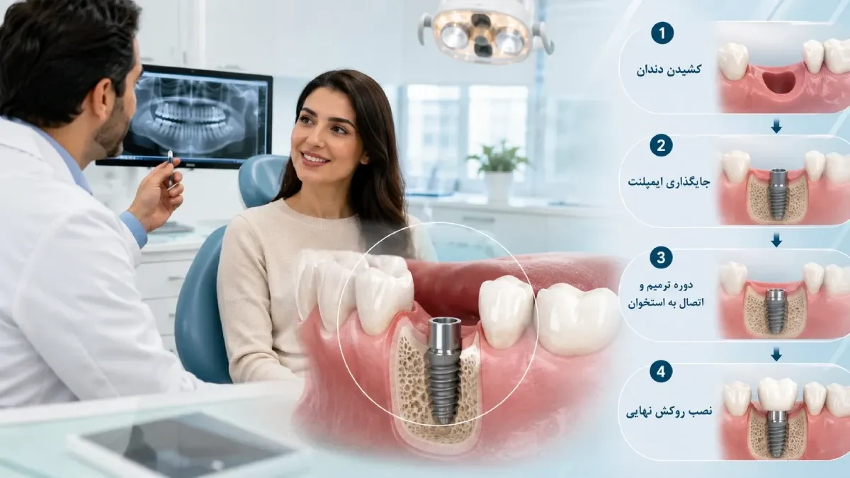 مراحل ایمپلنت دندان از کشیدن دندان تا نصب روکش