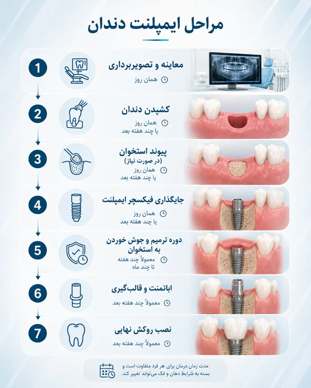 تایم‌لاین مراحل ایمپلنت دندان از کشیدن تا روکش نهایی
