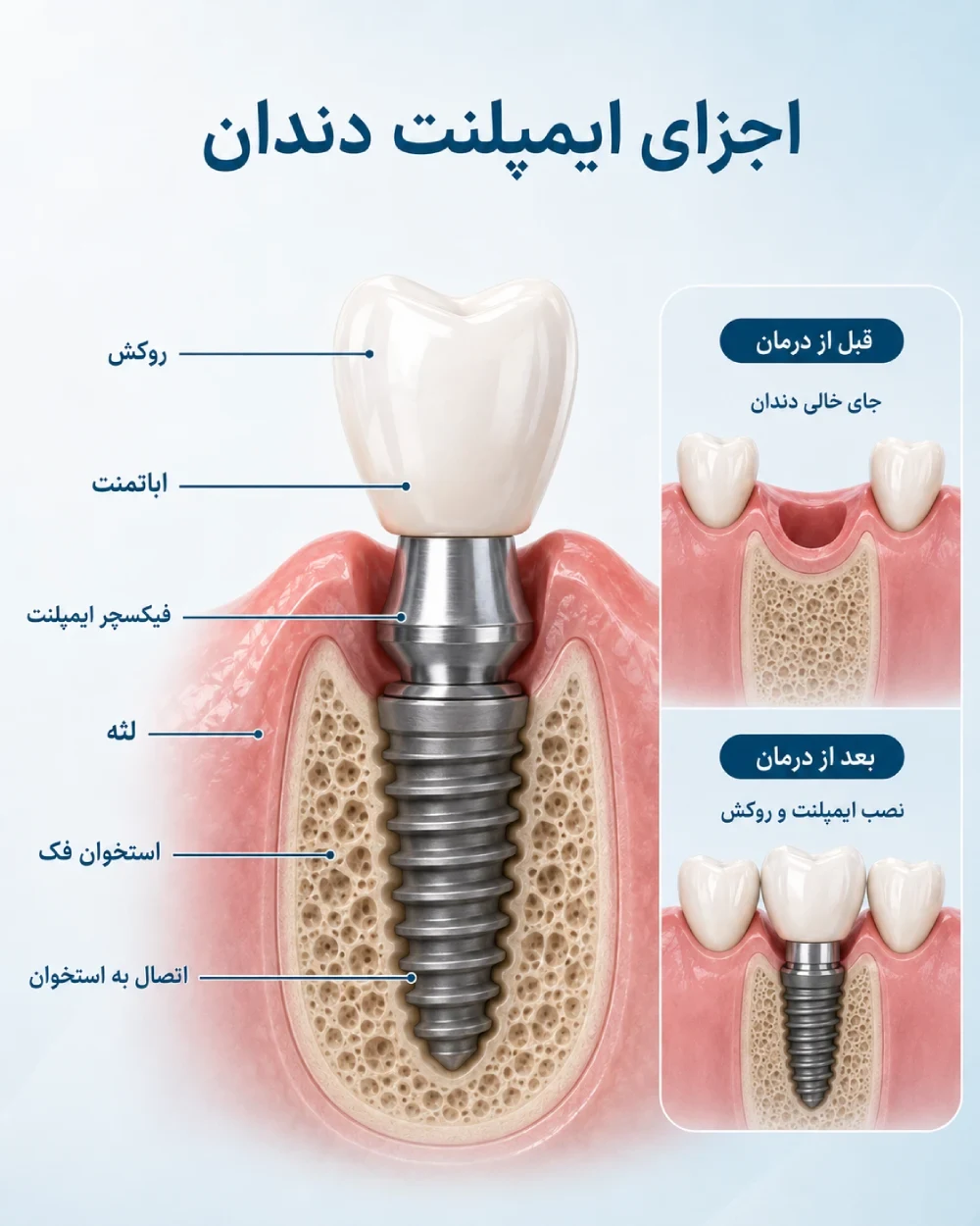 نمای CBCT محل ایمپلنت با استخوان، عصب فک و سینوس
