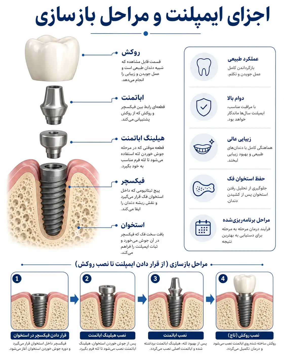 اجزای فیکسچر، هیلینگ اباتمنت، اباتمنت و روکش و ترتیب بازسازی دندان روی ایمپلنت