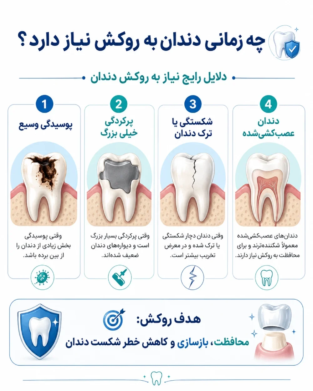 مسیر تصمیمگیری برای روکش دندان بر اساس پوسیدگی، شکستگی، پرکردگی بزرگ و عصبکشی