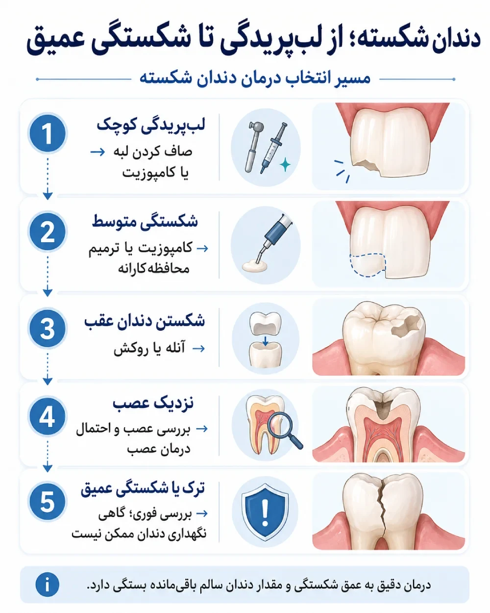 مسیر انتخاب درمان دندان شکسته از کامپوزیت تا روکش و درمان عصب