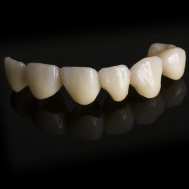 Monolithic zirconia restorations full arch implant supported with the ceramic load in vestibular, back background.